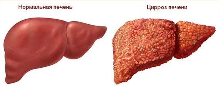 Цирроз Последняя Стадия Фото