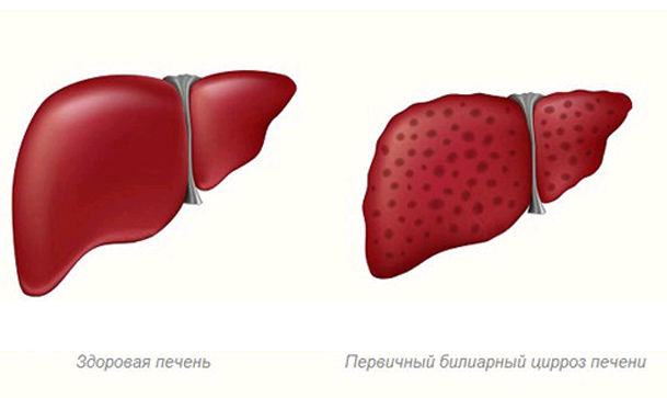 Первичный билиарный цирроз