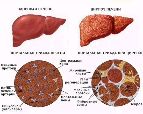 Первичный билиарный цирроз